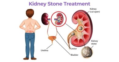 Kidney Stone Treatment