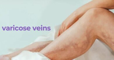 varicose veins treatment